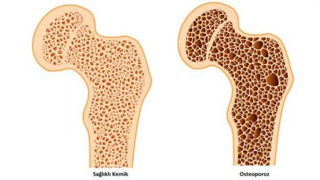 Osteoporoz Kemik Erimesi Obezite
