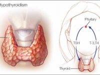 a medical illustration of hypothyroidism 16x91 1