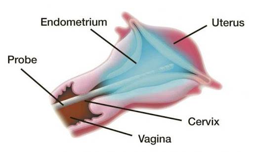 Endometrial Ablasyon 1