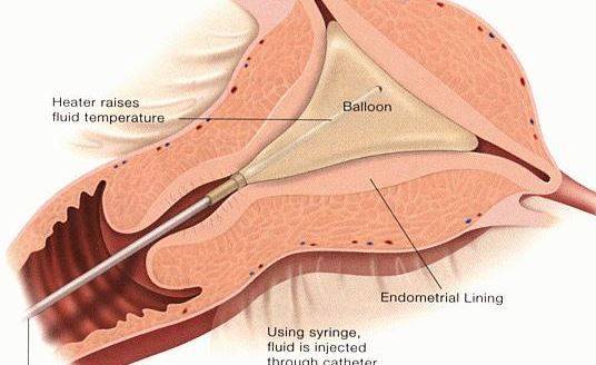 Endometrial Ablasyon etkileri