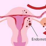 Endometriozis nedir
