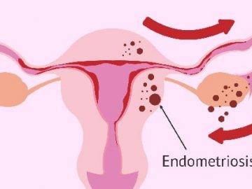 Endometriozis nedir