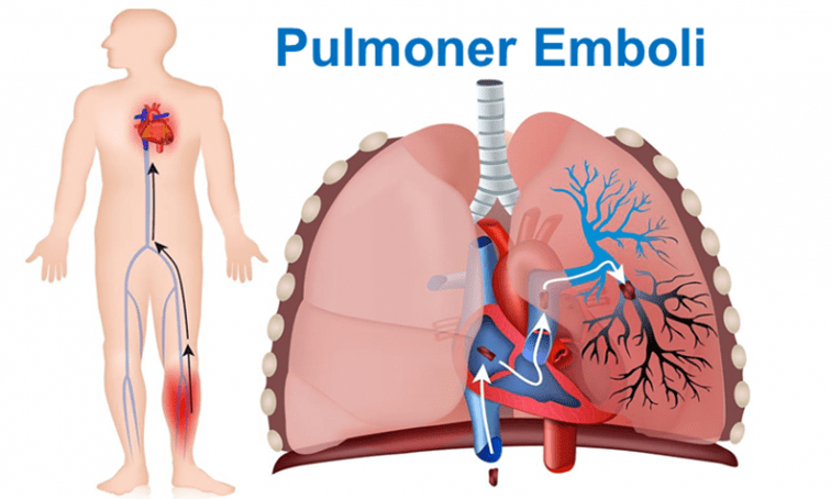 Pulmoner Emboli