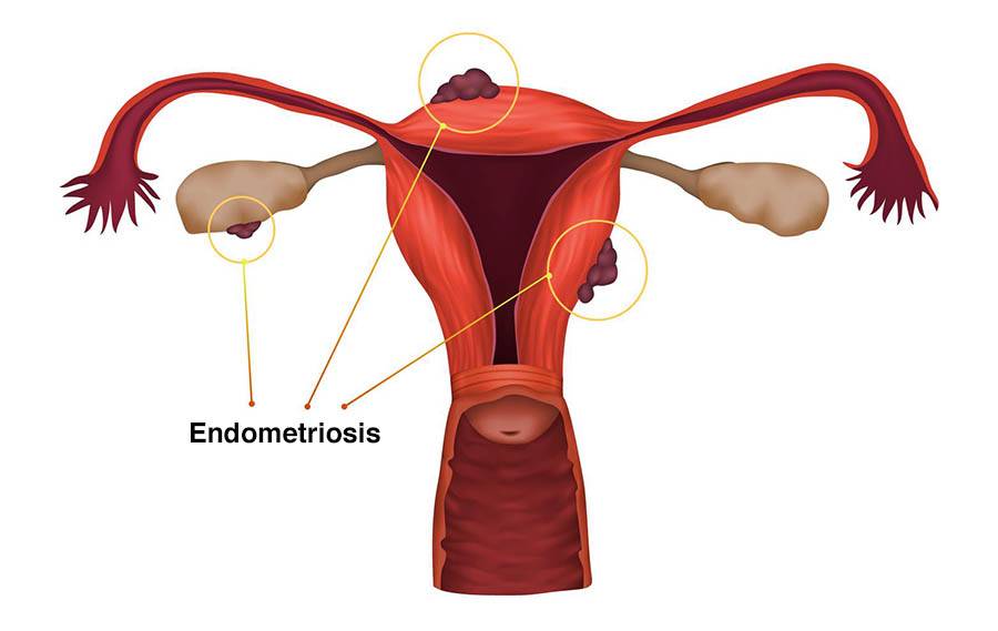 endometriosis illustration fcc644