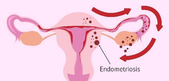 endometriozis rahim 1